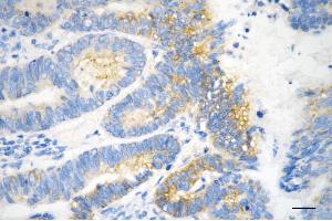 Immunohistochemistry was performed on paraffin-embedded human sigmoid colon carcinoma using PRKAR2A antibody (ABIN7800012), 1:200).