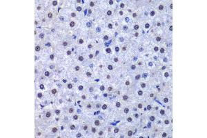 Immunohistochemistry of paraffin-embedded human liver cancer using GSTP1 antibody (ABIN5973328) at dilution of 1/200 (40x lens). (GSTP1 抗体)