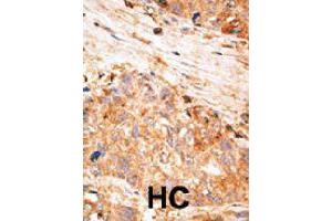 Formalin-fixed and paraffin-embedded human hepatocellular carcinoma tissue reacted with BIRC7 polyclonal antibody  , which was peroxidase-conjugated to the secondary antibody, followed by AEC staining. (BIRC7 抗体  (C-Term))
