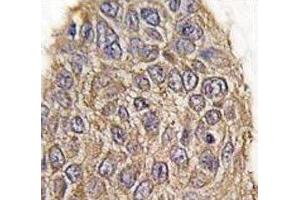 IHC analysis of FFPE human lung carcinoma tissue stained with Aldolase antibody (ALDOA 抗体  (AA 66-95))