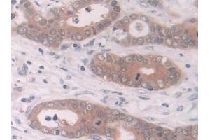 Detection of NQO1 in Human Stomach cancer Tissue using Polyclonal Antibody to NADH Dehydrogenase, Quinone 1 (NQO1)