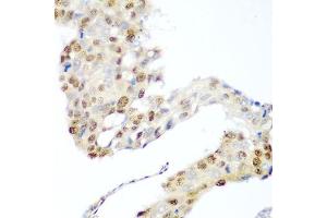 Immunohistochemistry of paraffin-embedded human lung cancer using CDK1 antibody. (CDK1 抗体  (AA 1-297))