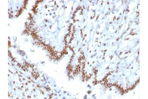 Formalin-fixed, paraffin-embedded human Endometrial Carcinoma stained with TLE1 Mouse Monoclonal Antibody (TLE1/2085).