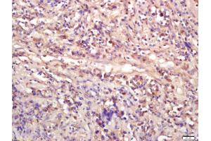 Formalin-fixed and paraffin embedded human lung carcinoma labeled with Anti-WNT9A Polyclonal Antibody, Unconjugated (ABIN675533) at 1:200 followed by conjugation to the secondary antibody and DAB staining (WNT9A 抗体  (AA 21-120))