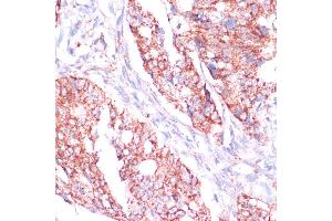 Immunohistochemistry of paraffin-embedded human colon carcinoma using RPL24 antibody (ABIN7269998) at dilution of 1:100 (40x lens). (RPL24 抗体  (AA 38-157))