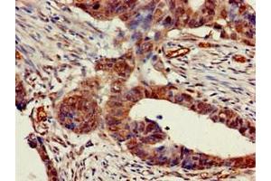 Immunohistochemistry of paraffin-embedded human colon cancer using ABIN7142959 at dilution of 1:100 (CHRNB1 抗体  (AA 24-244))