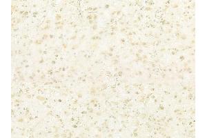 ABIN6260727 and ABIN6278679 at 1/100 staining human astrocytoma by IHC-P.
