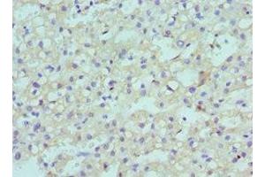 Immunohistochemistry of paraffin-embedded human liver cancer using ABIN7147709 at dilution of 1:100 (CBX8 抗体  (AA 80-280))