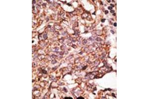 Formalin-fixed and paraffin-embedded human cancer tissue reacted with the primary antibody, which was peroxidase-conjugated to the secondary antibody, followed by AEC staining. (SIGLEC6 抗体  (C-Term))