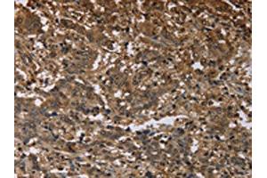 The image on the left is immunohistochemistry of paraffin-embedded Human liver cancer tissue using ABIN7191451(MFF Antibody) at dilution 1/25, on the right is treated with synthetic peptide. (MFF 抗体)