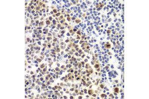 Immunohistochemistry of paraffin-embedded human amygdalitis using MSH6 antibody. (MSH6 抗体)