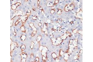 Immunohistochemistry of paraffin-embedded Human liver cancer using CD36 Polyclonal Antibody at dilution of 1:200 (40x lens). (CD36 抗体)