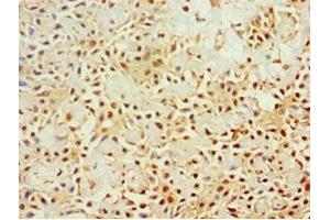 Immunohistochemistry of paraffin-embedded human breast cancer using ABIN7161640 at dilution of 1:100 (KLRC1 抗体  (AA 114-233))