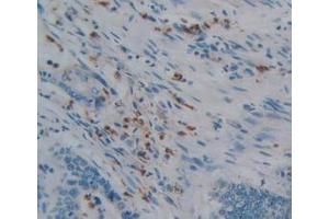 IHC-P analysis of Human Rectum Cancer Tissue, with DAB staining. (PTPRQ 抗体  (AA 36-294))