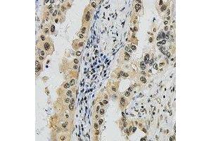 Immunohistochemical analysis of SUPT16H staining in human lung cancer formalin fixed paraffin embedded tissue section. (SUPT16H 抗体  (C-Term))