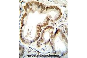 BTG2 Antibody (N-term) immunohistochemistry analysis in formalin fixed and paraffin embedded human prostate carcinoma followed by peroxidase conjugation of the secondary antibody and DAB staining. (BTG2 抗体  (N-Term))