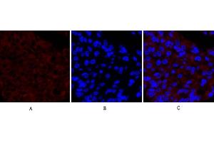Immunofluorescence analysis of human liver cancer tissue.