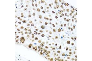 Immunohistochemistry of paraffin-embedded human lung cancer using METTL3 antibody. (METTL3 抗体  (AA 1-156))