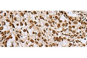 Immunohistochemistry of paraffin-embedded Human esophagus cancer tissue using MYEF2 Polyclonal Antibody at dilution of 1:70(x200) (MYEF2 抗体)