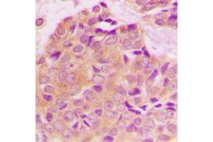 Immunohistochemical analysis of 14-3-3 zeta (pS58) staining in human breast cancer formalin fixed paraffin embedded tissue section.