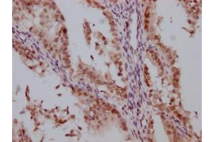 IHC image of ABIN7127539 diluted at 1:100 and staining in paraffin-embedded human endometrial cancer performed on a Leica BondTM system.