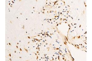 ABIN6267303 at 1/100 staining human glioma tissue sections by IHC-P. (C-JUN 抗体  (pSer63))