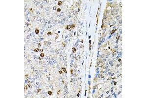 Immunohistochemistry of paraffin-embedded human prostate cancer using PNKP antibody. (PNKP 抗体  (AA 60-320))