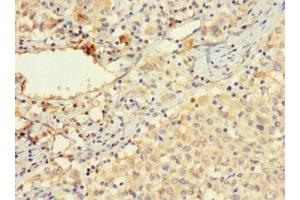 Immunohistochemistry of paraffin-embedded human lung cancer using ABIN7175557 at dilution of 1:100 (Vitronectin 抗体  (AA 31-105))
