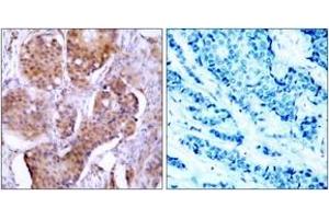 Immunohistochemistry analysis of paraffin-embedded human breast carcinoma, using Estrogen Receptor-alpha (Phospho-Ser106) Antibody. (Estrogen Receptor alpha 抗体  (pSer106))