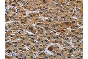 The image on the left is immunohistochemistry of paraffin-embedded Human liver cancer tissue using ABIN7191086(IL31 Antibody) at dilution 1/20, on the right is treated with synthetic peptide. (IL-31 抗体)