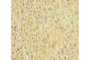 Immunohistochemistry of paraffin-embedded human liver cancer using ABIN7155002 at dilution of 1:100 (HEPACAM2 抗体  (AA 32-351))