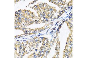 Immunohistochemistry of paraffin-embedded human gastric cancer using EPB41 antibody (ABIN1872554) at dilution of 1:100 (40x lens). (EPB41 抗体)