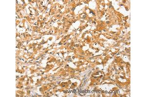 Immunohistochemistry of Human liver cancer using APTX Polyclonal Antibody at dilution of 1:50 (Aprataxin 抗体)
