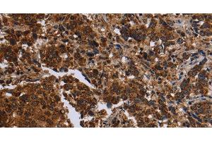 Immunohistochemistry of paraffin-embedded Human liver cancer tissue using FMN2 Polyclonal Antibody at dilution 1:30 (Formin 2 抗体)