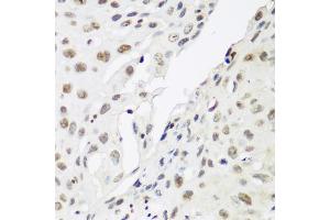 Immunohistochemistry of paraffin-embedded human lung cancer using CBX3 antibody. (CBX3 抗体)