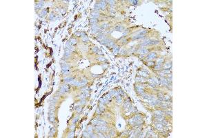 Immunohistochemistry of paraffin-embedded human colon carcinoma using CSH1 antibody at dilution of 1:100 (40x lens). (CSH1 抗体)