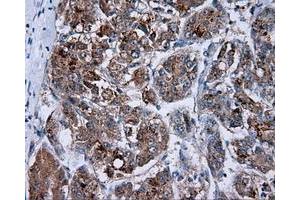 Immunohistochemical staining of paraffin-embedded Carcinoma of prostate tissue using anti-RC201933 mouse monoclonal antibody. (PIM2 抗体)
