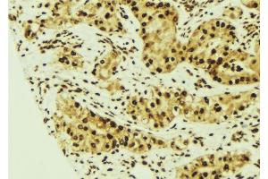 ABIN6275527 at 1/100 staining Human breast cancer tissue by IHC-P. (STK24 抗体  (N-Term))