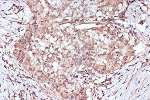 Immunohistochemistry of paraffin-embedded human esophageal cancer using B Rabbit mAb (ABIN7265849) at dilution of 1:100 (40x lens). (BAG2 抗体)