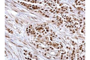 IHC-P Image Rb antibody detects Rb protein at nucleus on human colon carcinoma by immunohistochemical analysis. (Retinoblastoma 1 抗体  (C-Term))