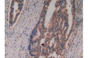 IHC-P analysis of Human Rectum Cancer Tissue, with DAB staining. (Caspase 8 抗体  (AA 7-216))