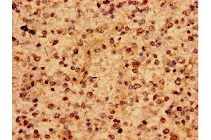 Immunohistochemistry of paraffin-embedded human glioma using ABIN7167217 at dilution of 1:100 (RAB1A 抗体  (AA 1-196))