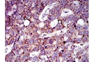 Immunohistochemical analysis of paraffin-embedded esophageal cancer tissues using MRPL42 mouse mAb with DAB staining. (MRPL42 抗体  (AA 10-142))