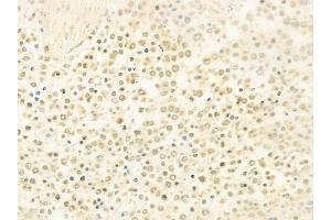 ABIN6263496 and ABIN6278768 at 1/100 staining human Hodgkin lymphoma by IHC-P. (KAT6B 抗体  (C-Term))