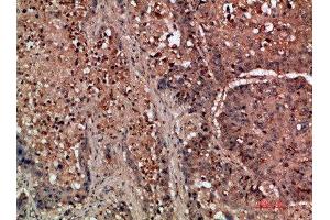 Immunohistochemical analysis of paraffin-embedded human-lung-cancer, antibody was diluted at 1:200 (DDR2 抗体  (AA 31-80))