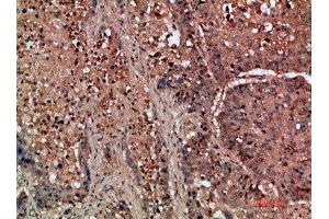 Immunohistochemical analysis of paraffin-embedded human-lung-cancer, antibody was diluted at 1:200 (DDR2 抗体  (AA 31-80))