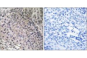 Immunohistochemistry analysis of paraffin-embedded human breast carcinoma tissue, using TEBP (Ab-113) Antibody. (NKX2-1 抗体  (AA 79-128))
