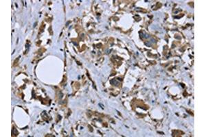 The image on the left is immunohistochemistry of paraffin-embedded Human breast cancer tissue using ABIN7130317(MYL12B Antibody) at dilution 1/20, on the right is treated with fusion protein. (MYL12B 抗体)