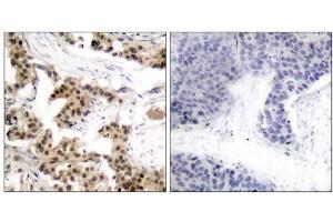 Immunohistochemical analysis of paraffin-embedded human breast carcinoma tissue using NF-κB p105/p50 (phospho-Ser893) antibody (E011018). (NFKB1 抗体  (pSer893))