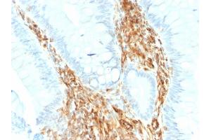 Formalin-fixed, paraffin-embedded human Colon Carcinoma stained with Vimentin Rabbit Recombinant Monoclonal Antibody (VIM/1937R). (Recombinant Vimentin 抗体)